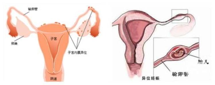 不孕不育