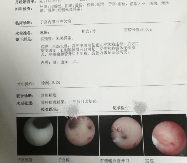 卵巢早衰